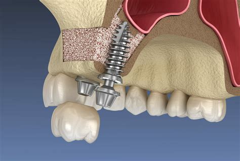 sinus lift port salerno fl|SINUS INFECTION TREATMENT in Port Salerno .